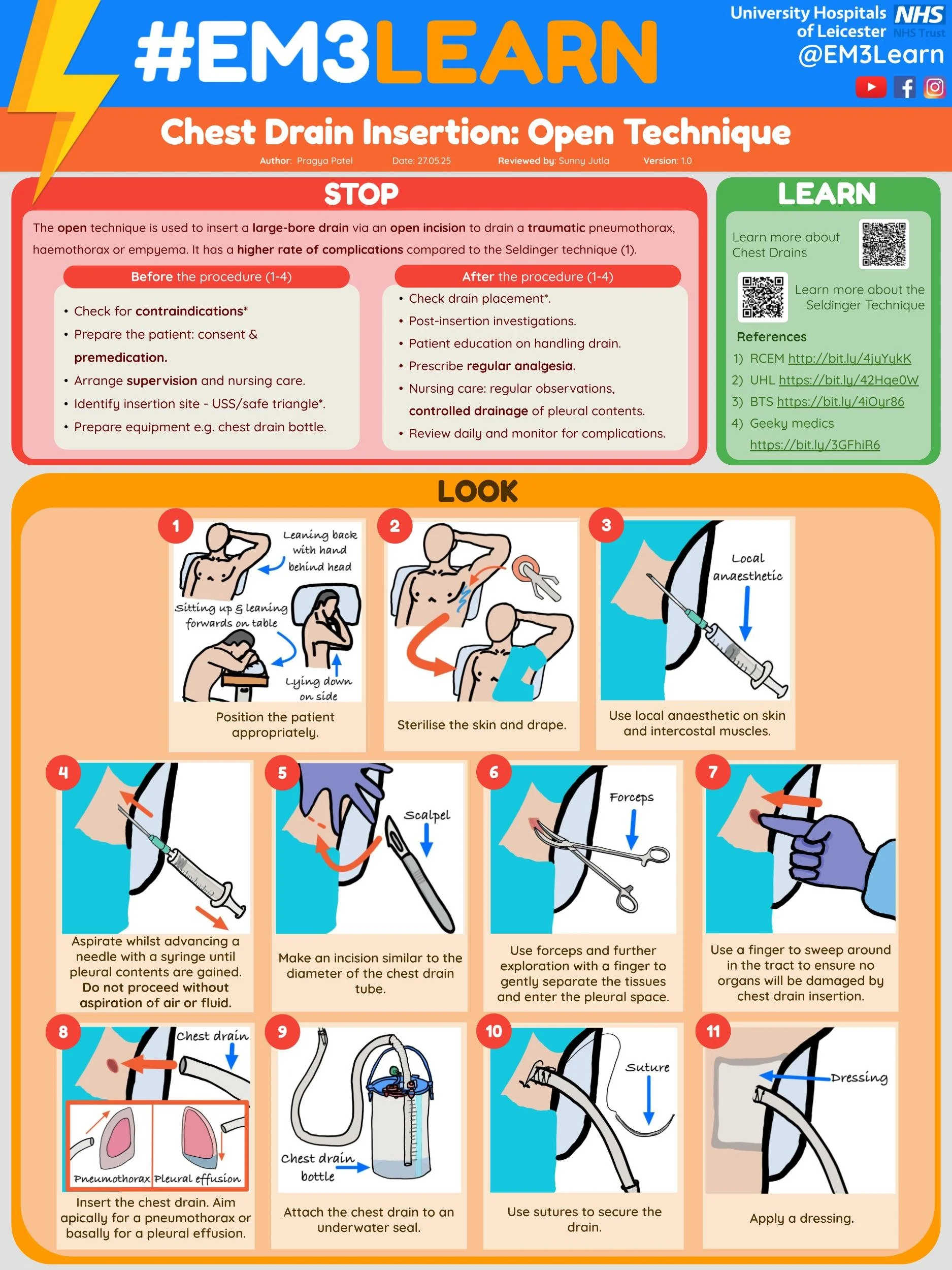 Chest Drain Insertion: Open Technique