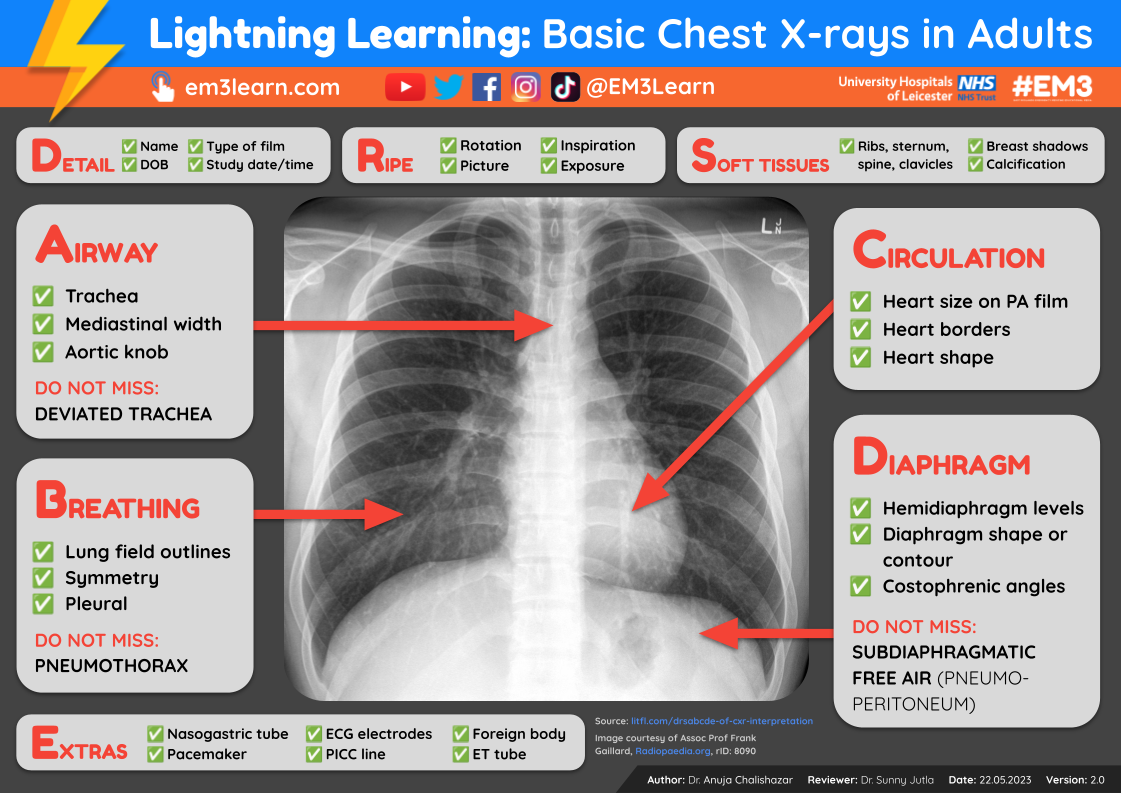 Basic Chest X-rays in Adults