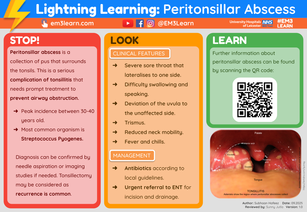 Peritonsillar Abscess