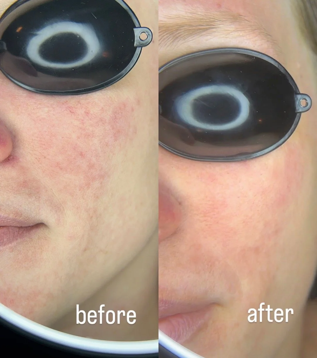 rosacea treatment