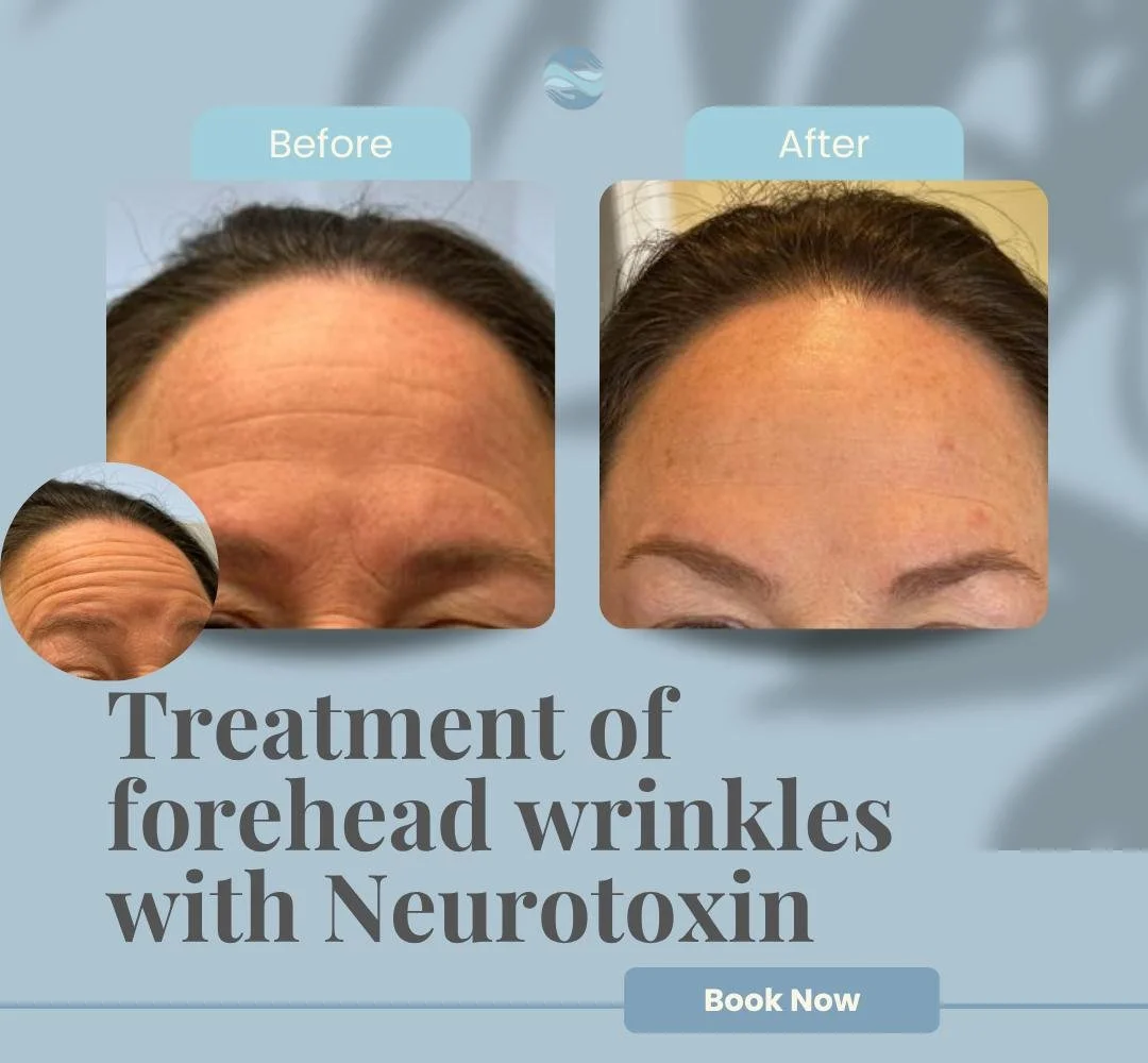 Before and after PRF treatment Oradell NJ