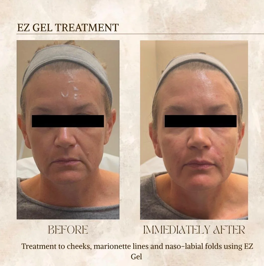 Before and after PRF treatment Oradell NJ