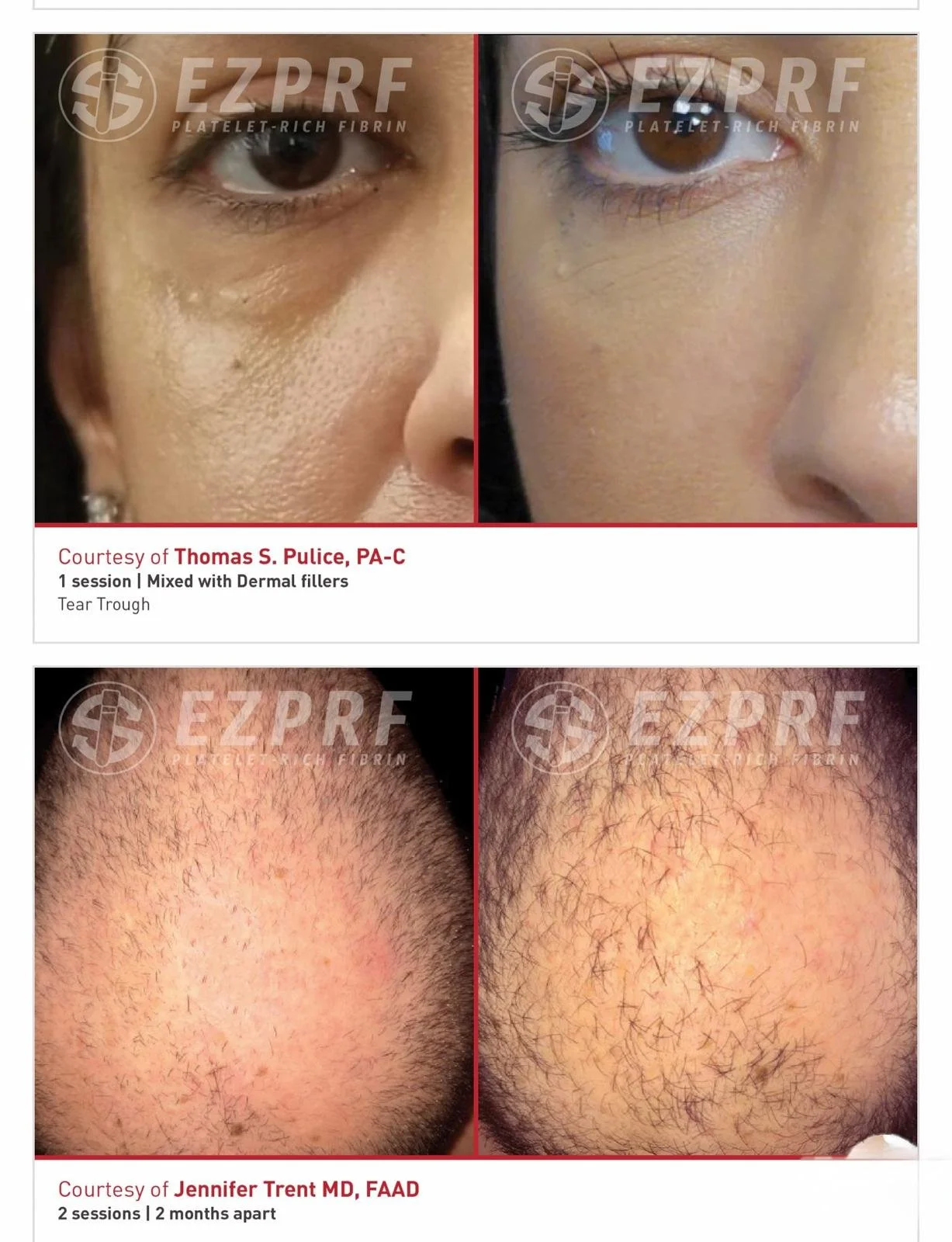 Before and after PRF treatment Oradell NJ