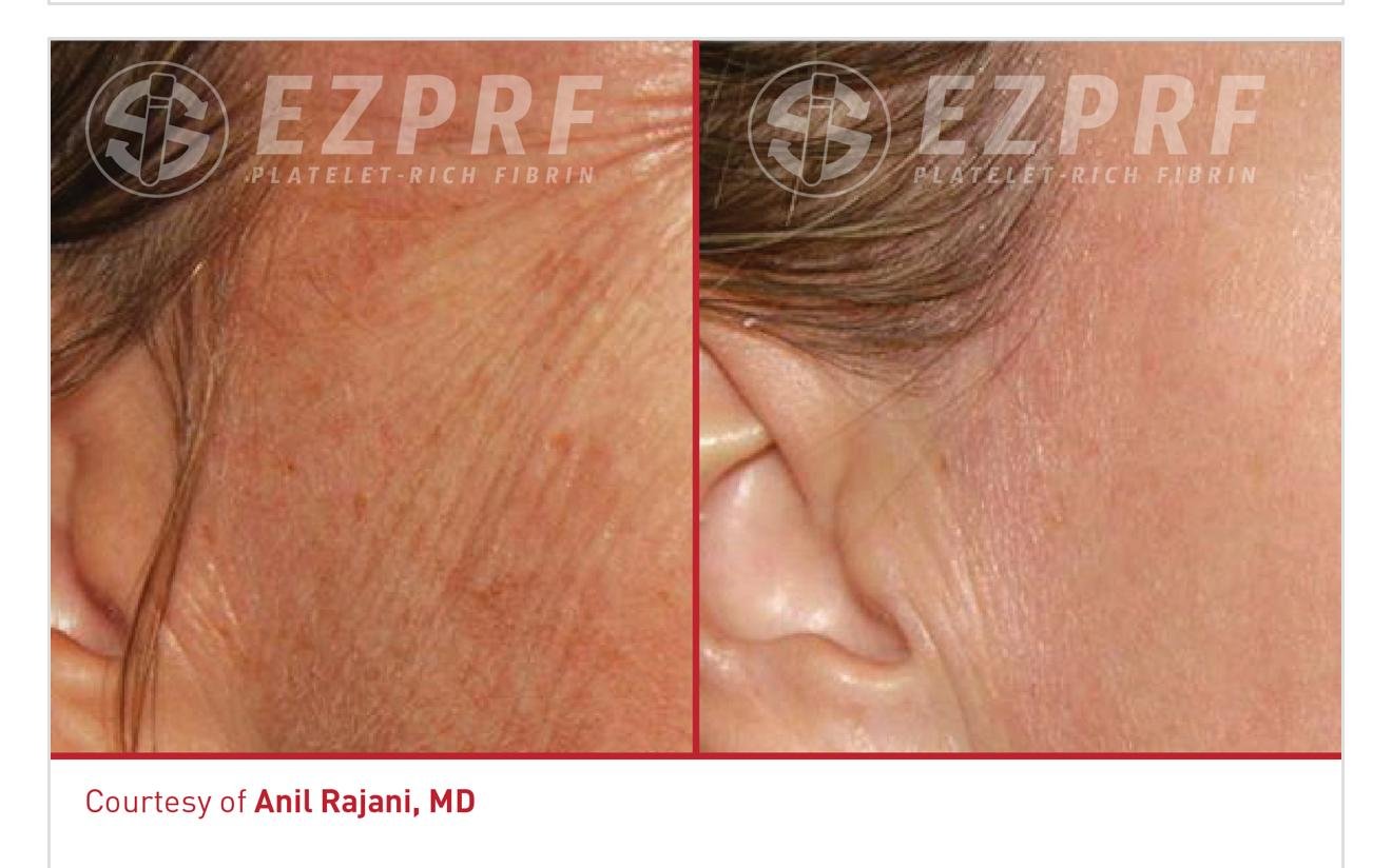 Before and after PRF treatment Oradell NJ