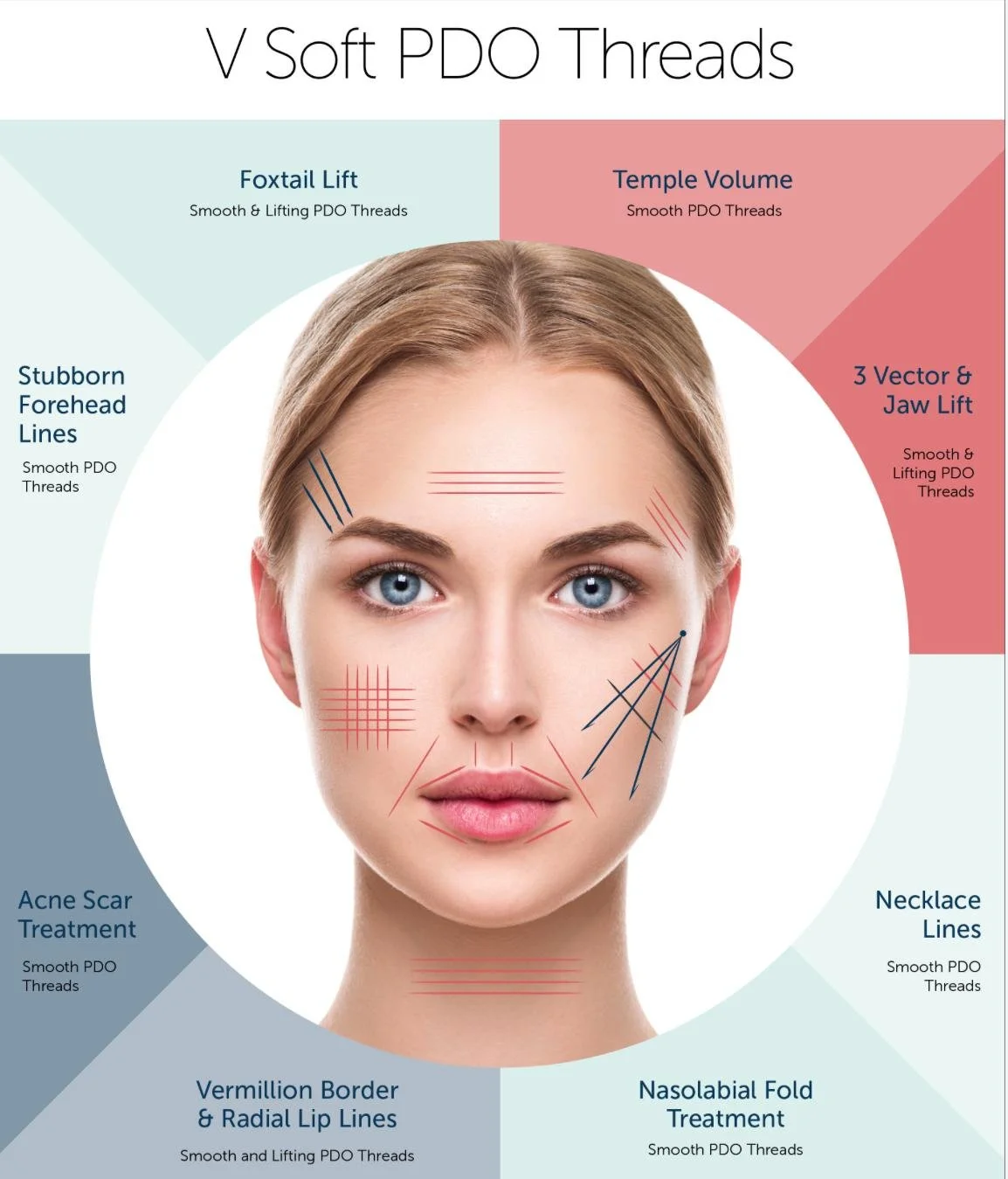 Diagram of facial areas for V Soft PDO thread treatments. The face is annotated with lines indicating specific treatment zones, including forehead, eyebrows, cheeks, nose, and chin, with descriptions of treatment types such as smooth PDO threads, lifting PDO threads, and stitch marks for different procedures.