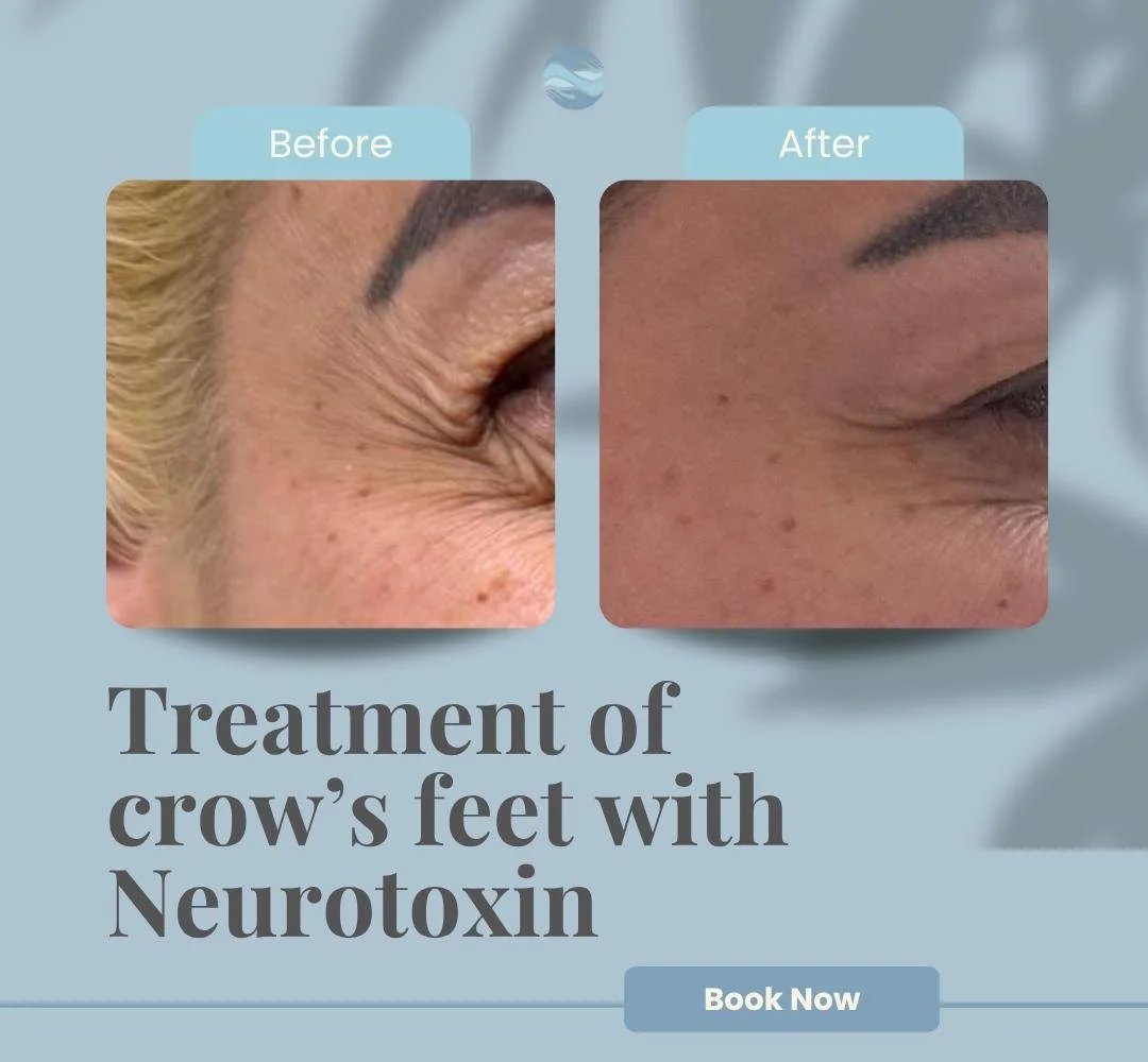 Before and after PRF treatment Oradell NJ