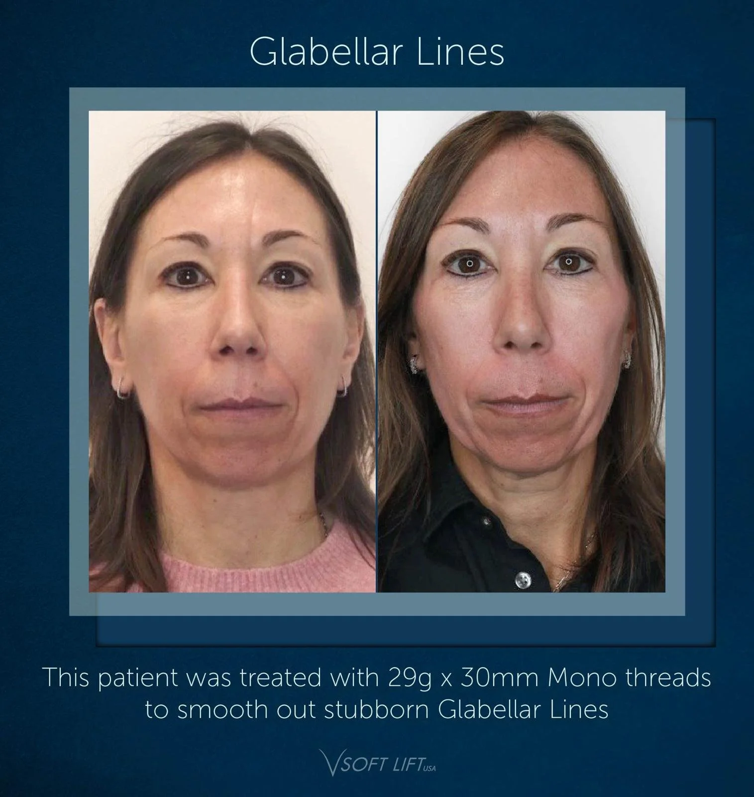 Before and after PRF treatment Oradell NJ