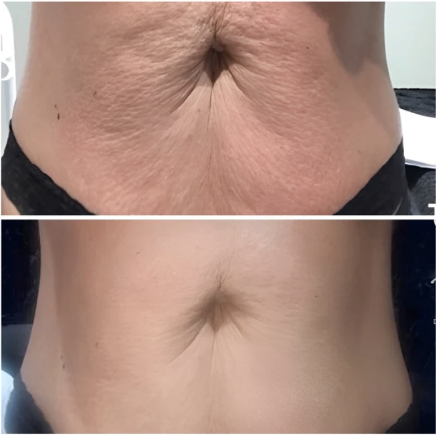 Before-and-after image of the abdominals treated with the T‑Shape 2, showing a noticeable reduction in cellulite, improved skin texture, and a firmer, smoother appearance.