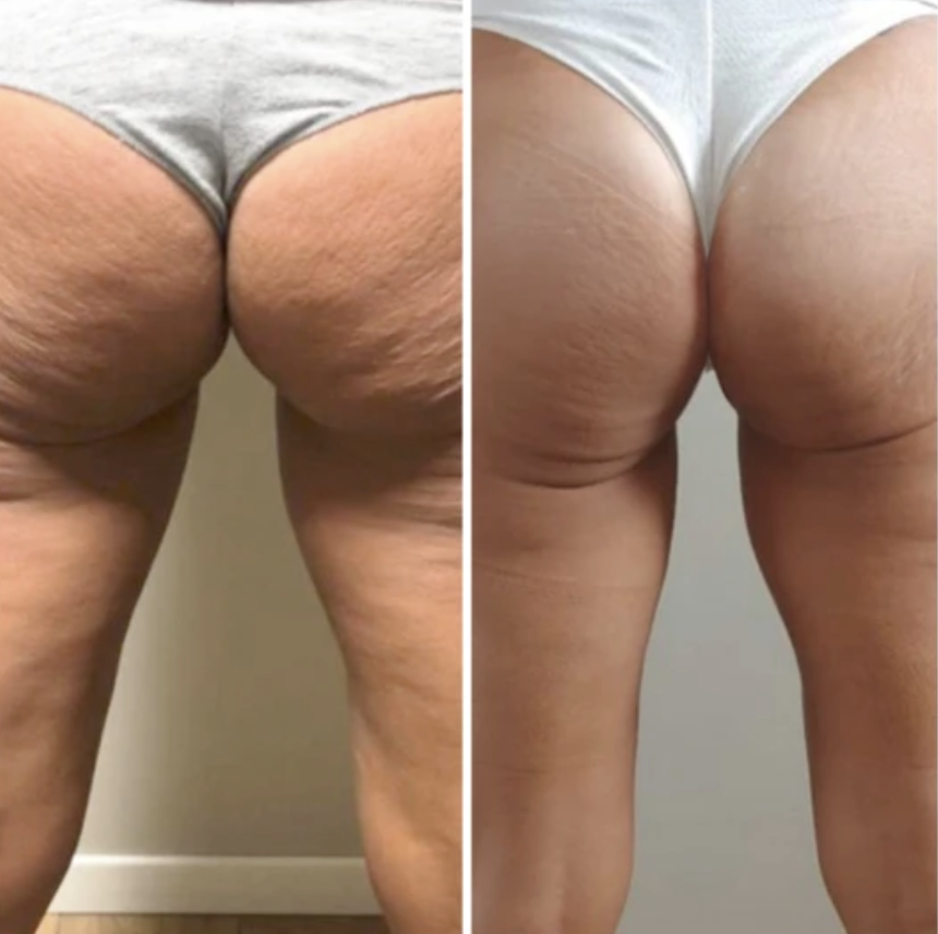 Before-and-after image of glutes and thighs treated with the T‑Shape 2, showing significant reduction in cellulite, improved skin texture, and a smoother, lifted appearance.