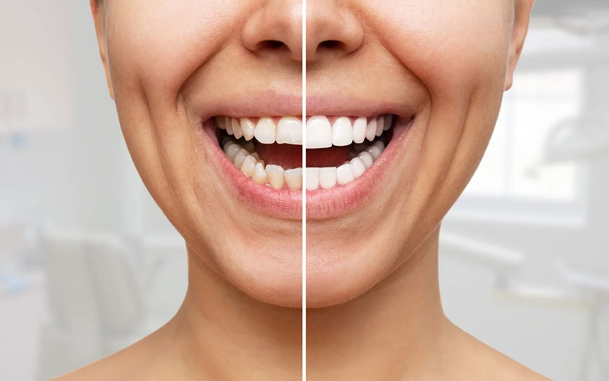 A person smiling; on the left side, the teeth look slightly more yellow than on the right side.