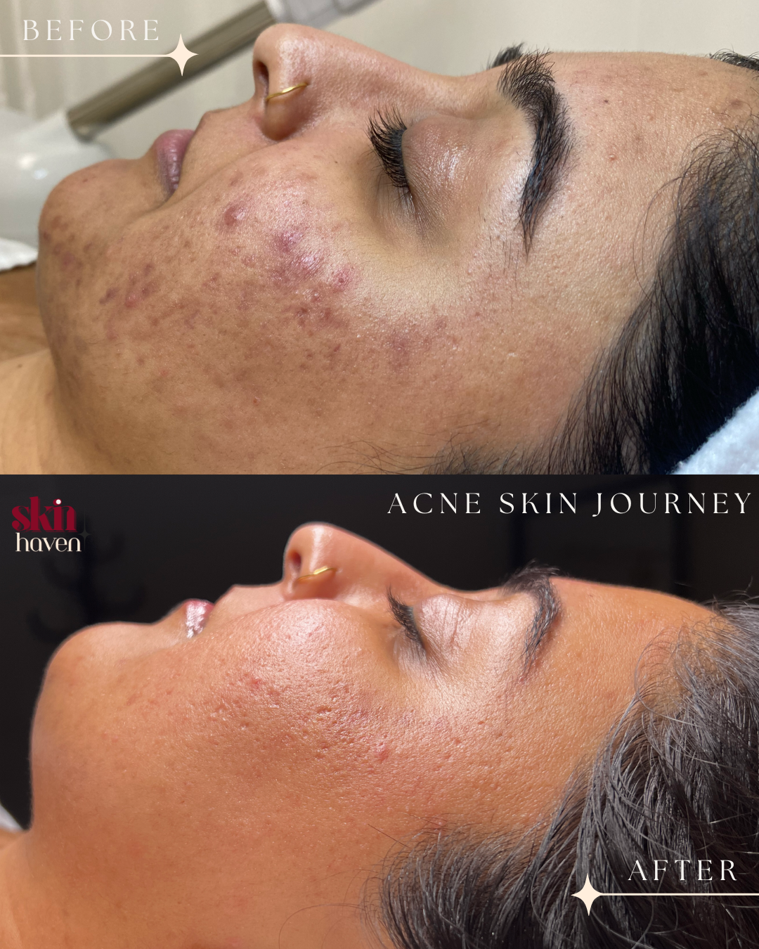 Before and after images of a woman’s face showing improvement in acne-prone skin, with noticeable reduction in acne scars and inflammation after skincare treatment.