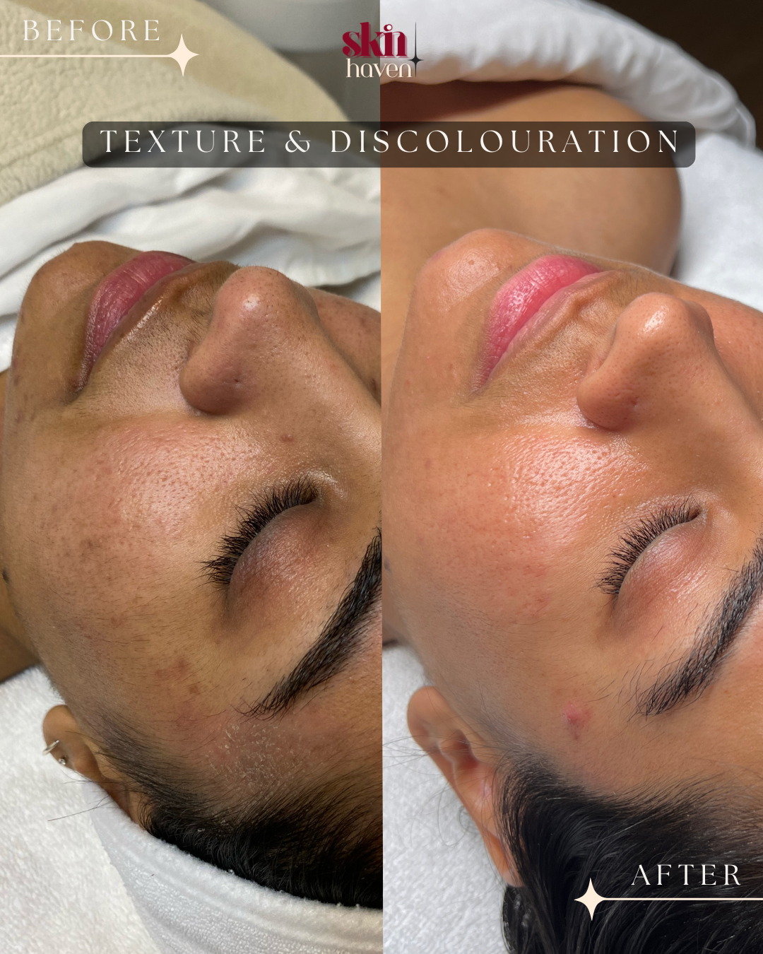 Side-by-side comparison of a woman's face before and after a skin treatment, showing improved skin texture and reduced discoloration.