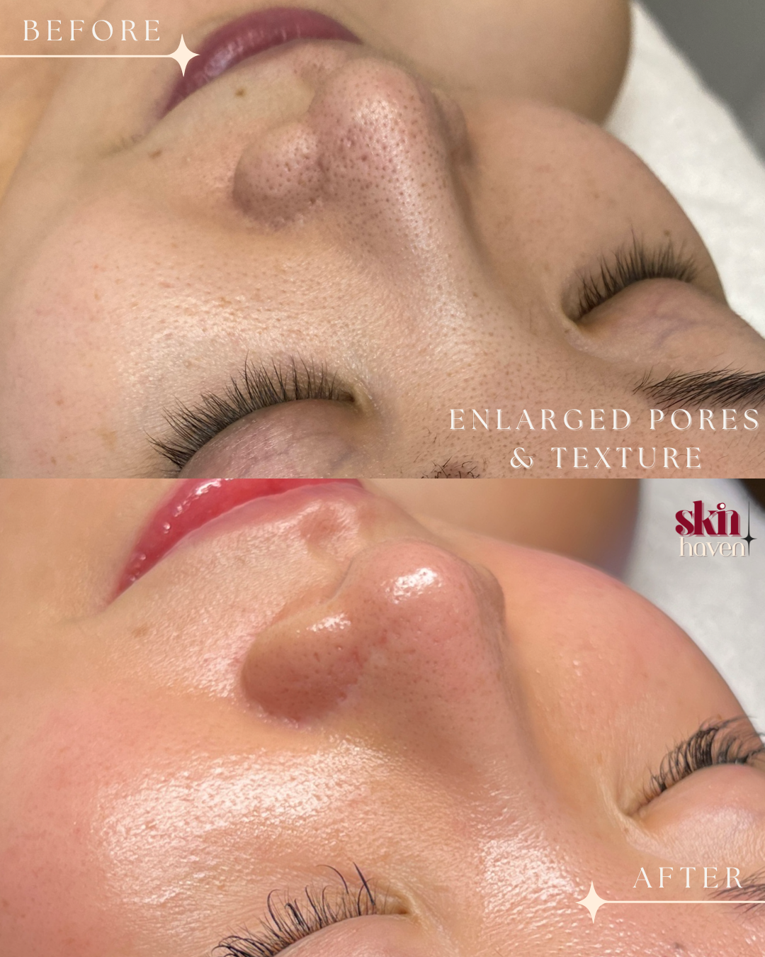 Close-up comparison of a person's nose and cheek area before and after a pore-reducing facial treatment, showing enlarged pores and texture in the 'before' image and smoother, more refined skin in the 'after' image.