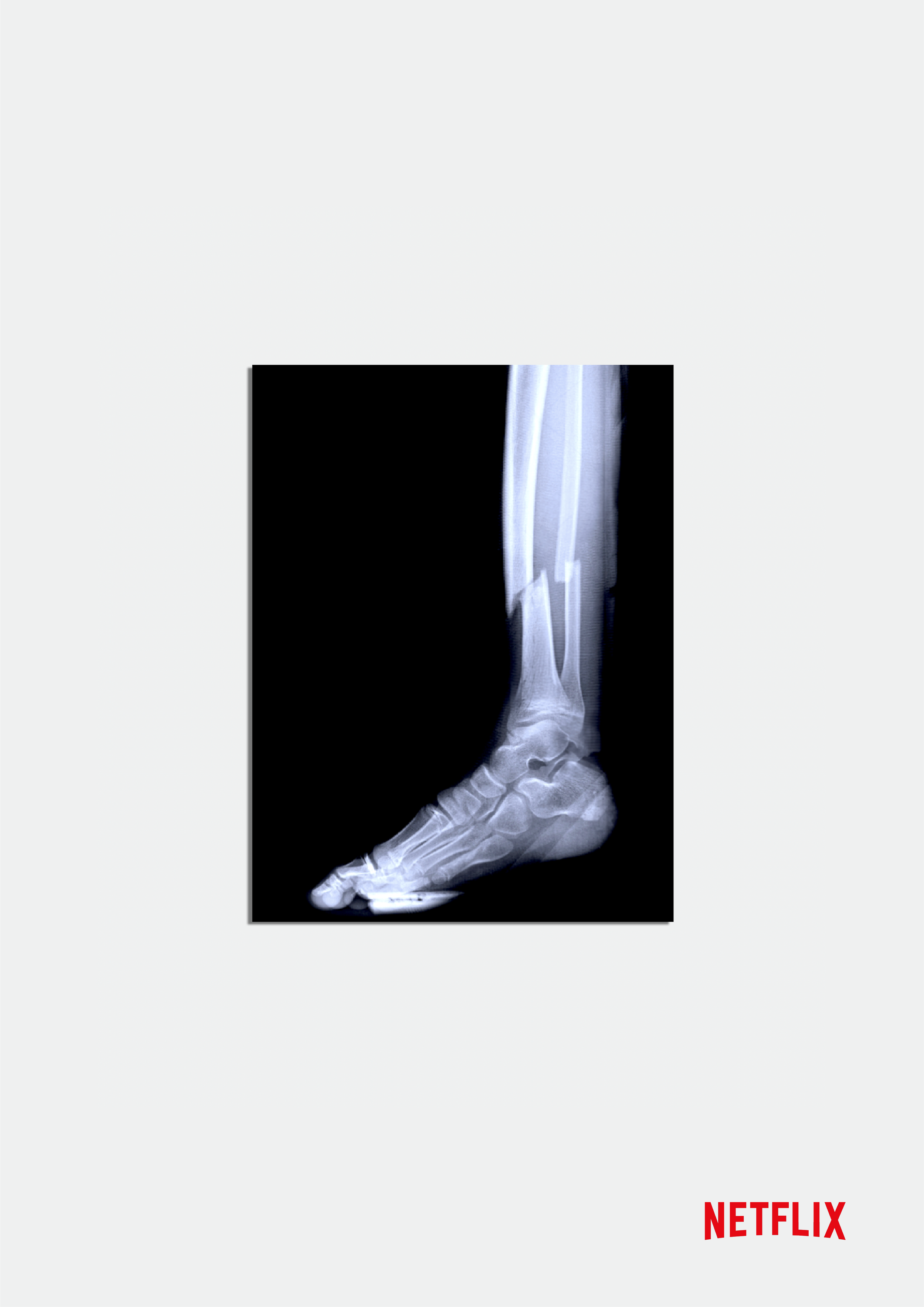 Netflix Broken Leg.png