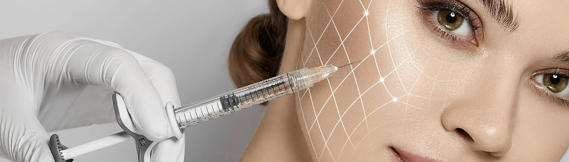 Precise under‑eye Botox injection guided by facial mapping lines.