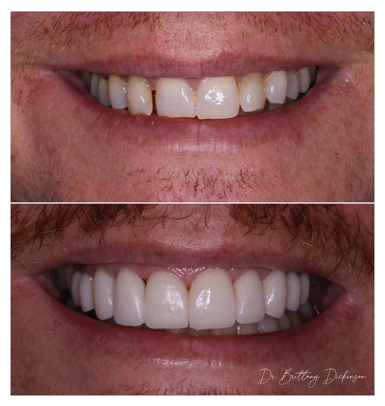 Porcelain veneers closing front tooth gap and lengthening worn short teeth, before and after smile makeover by AACD member Dr. Brittany Dickinson