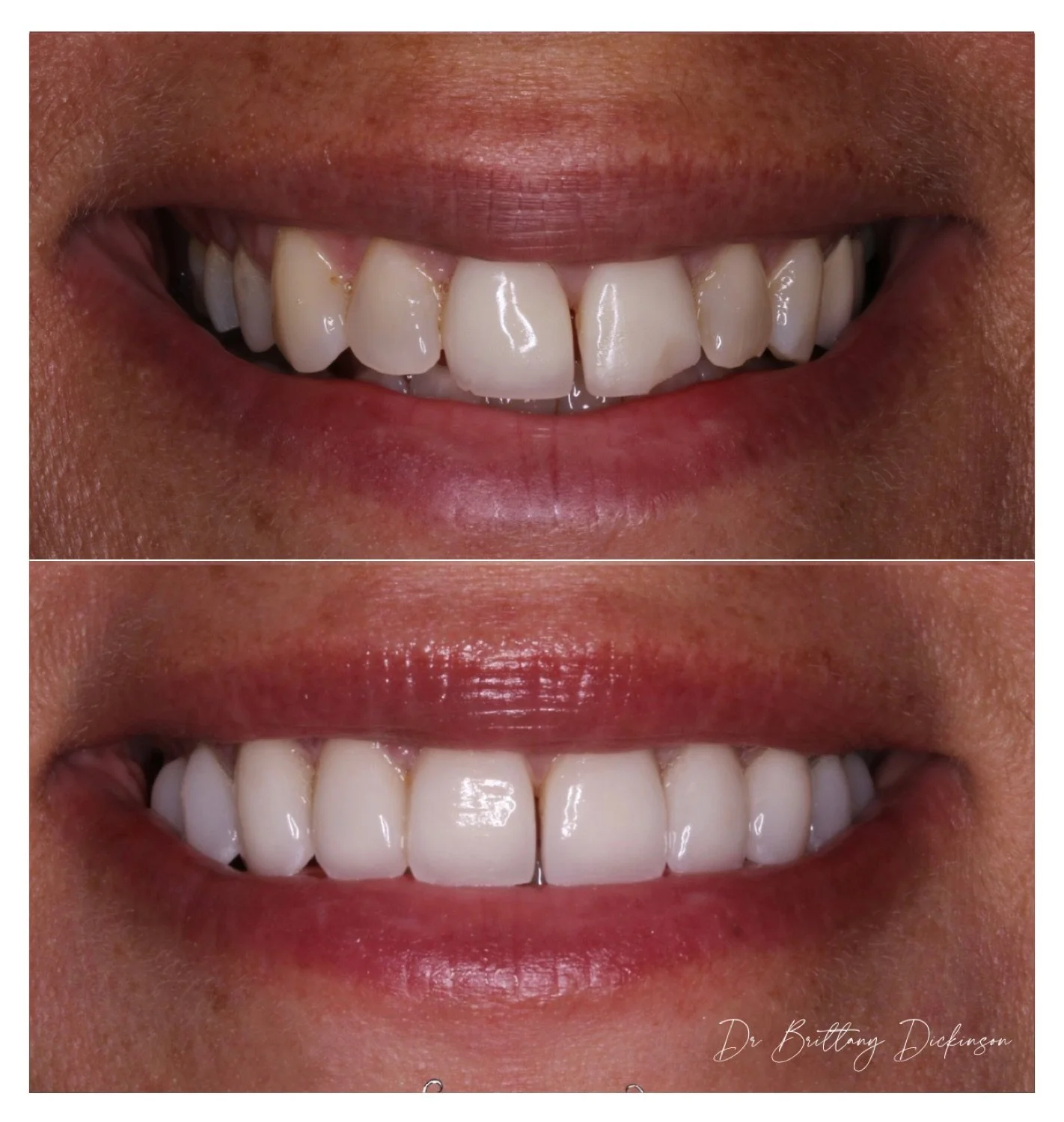Porcelain veneers with the gap preserved before and after by Dr. Brittany Dickinson, Chicago Lakeview.