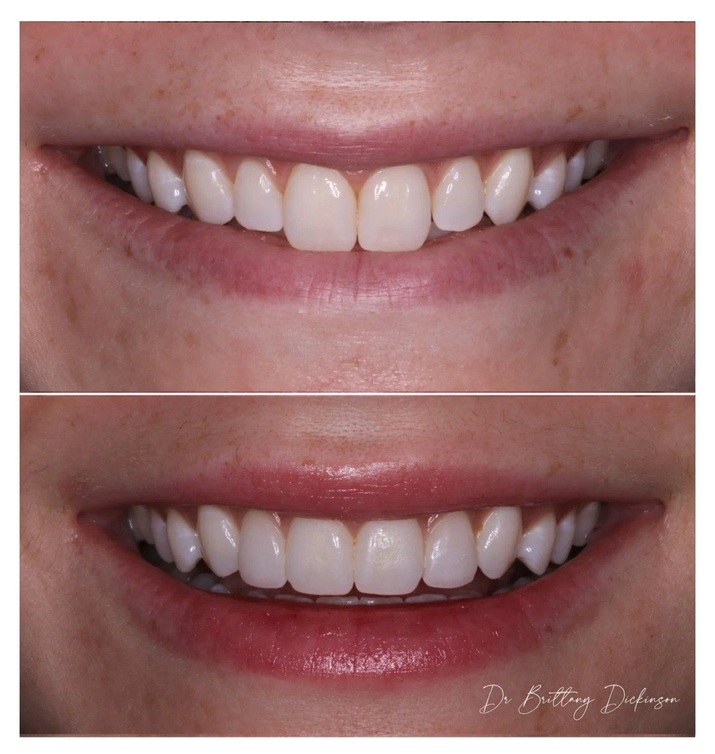 2 porcelain veneers for small laterals before and after by Dr. Brittany Dickinson, Chicago Aesthetic Dentistry, Lakeview.