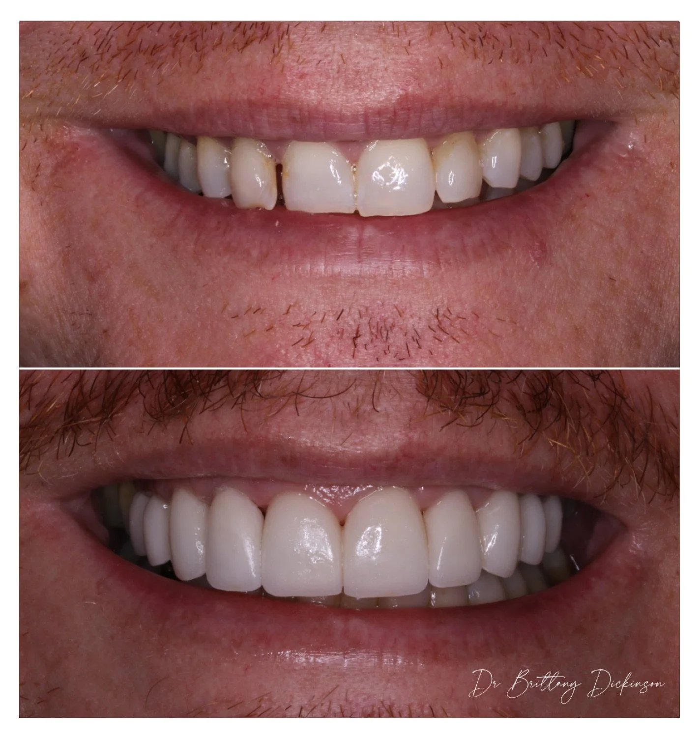 20 porcelain veneers before and after by Dr. Brittany Dickinson, Chicago Aesthetic Dentistry, Lakeview.