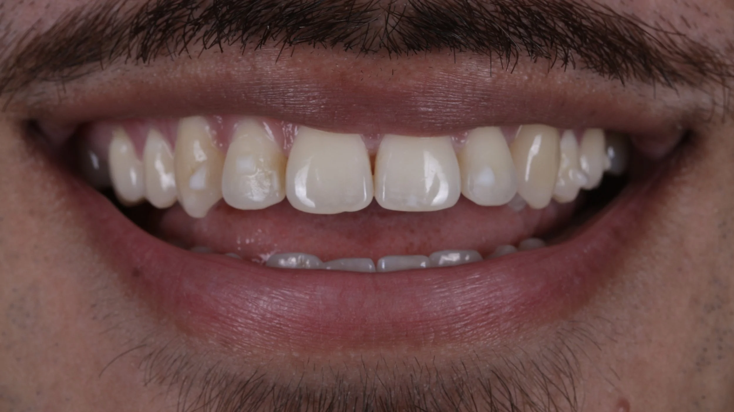 Close-up of Invisalign aligner with tooth-colored attachments at Chicago Aesthetic Dentistry in Lakeview — clear orthodontic treatment for adults.