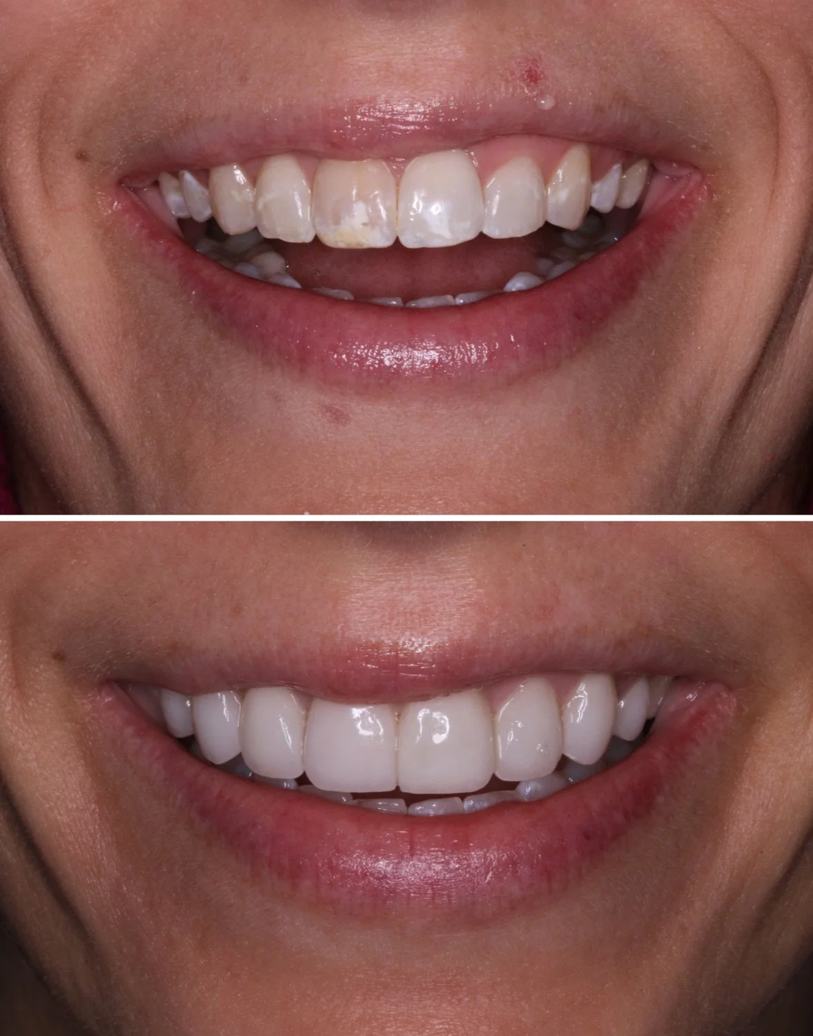 8 porcelain veneers before and after by Dr. Brittany Dickinson, Chicago Aesthetic Dentistry, Lakeview.