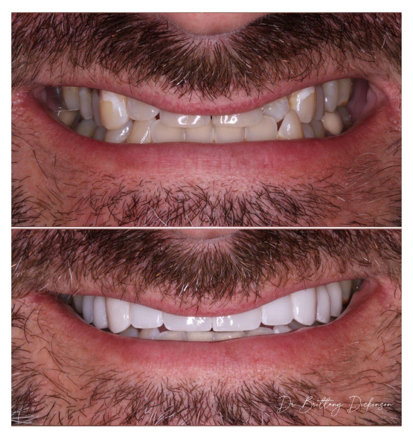 13 porcelain veneers to jump crossbite before and after by Dr. Brittany Dickinson, Chicago Aesthetic Dentistry, Lakeview.