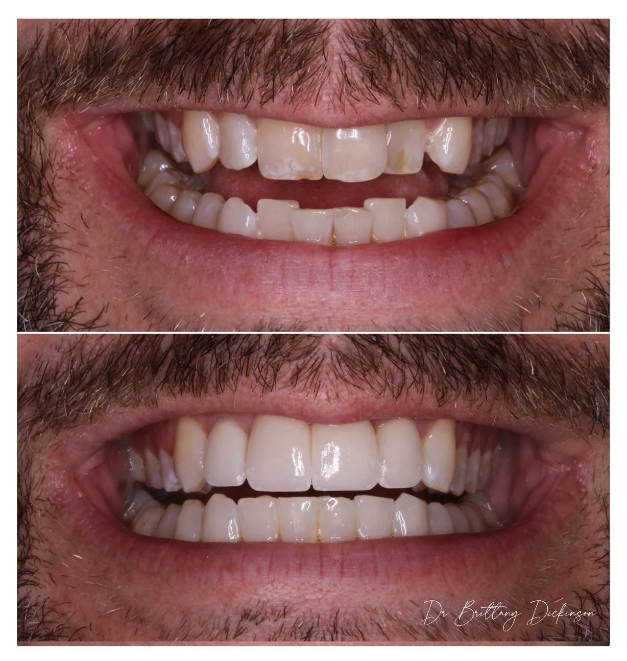 Invisalign First, Then Veneers? Why the Right Order Changes Everything