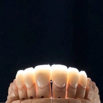 Will My Veneers Look Fake? How to Avoid the "Chiclet" Smile (A Chicago Cosmetic Dentist's Honest Answer)