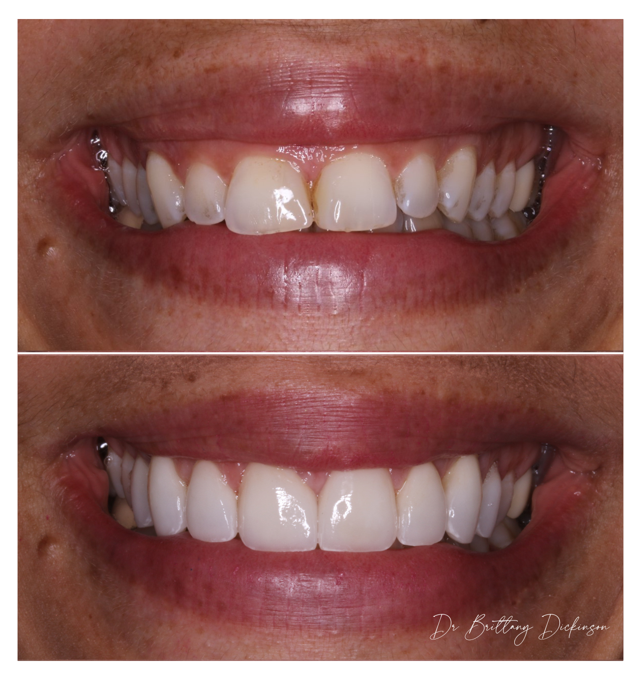 Gum Contouring in Chicago: What It Costs, What It Fixes, and Who's a Good Candidate