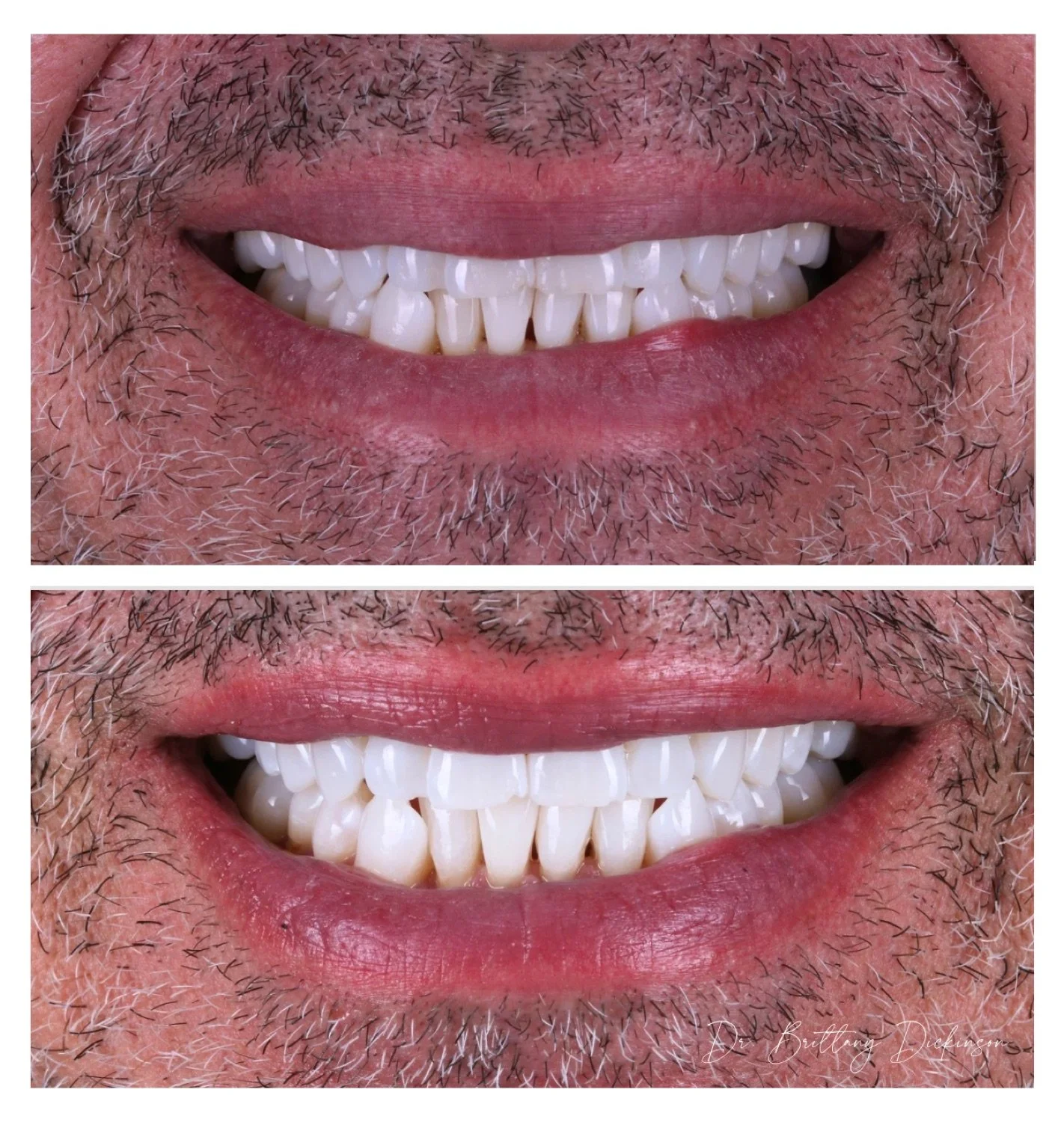 Zoom Whitening vs. Take-Home Trays: A Chicago Cosmetic Dentist's Honest Guide to Choosing