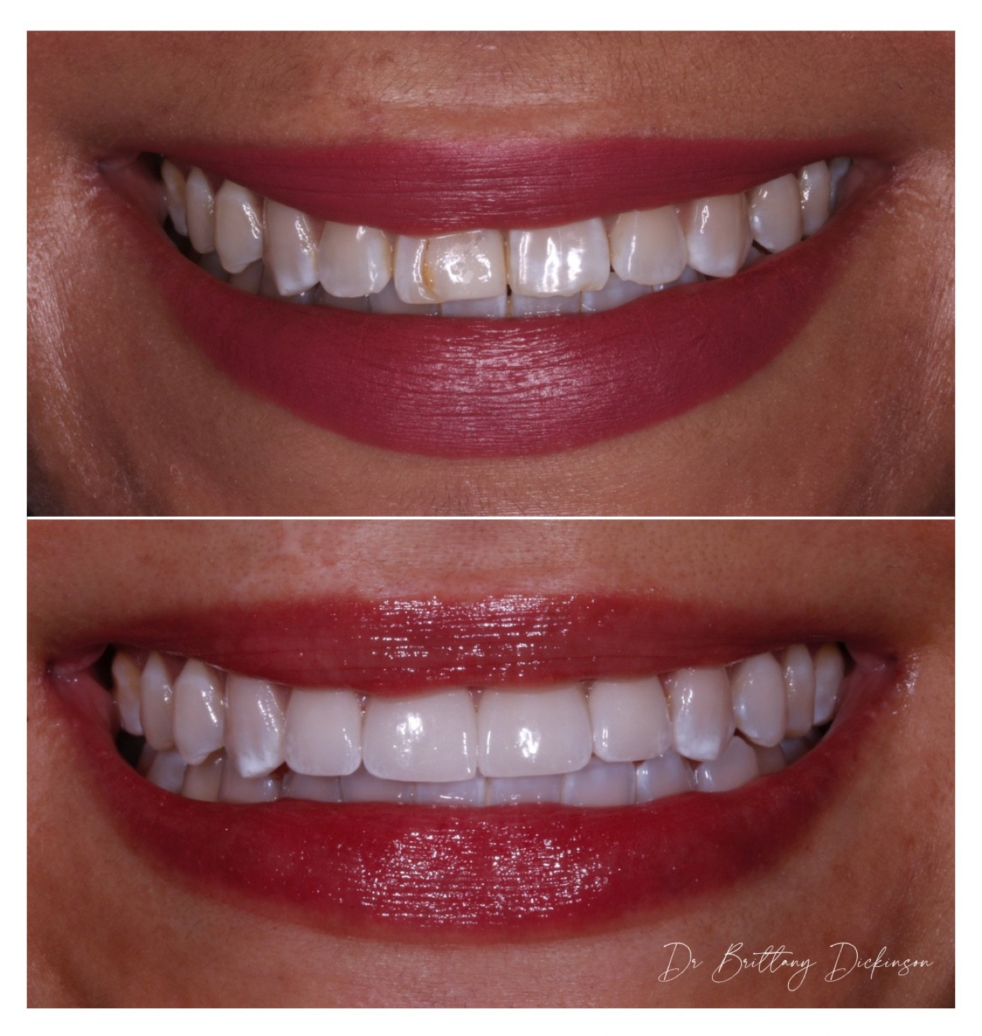 Veneers vs. Crowns: Which One Do You Actually Need?