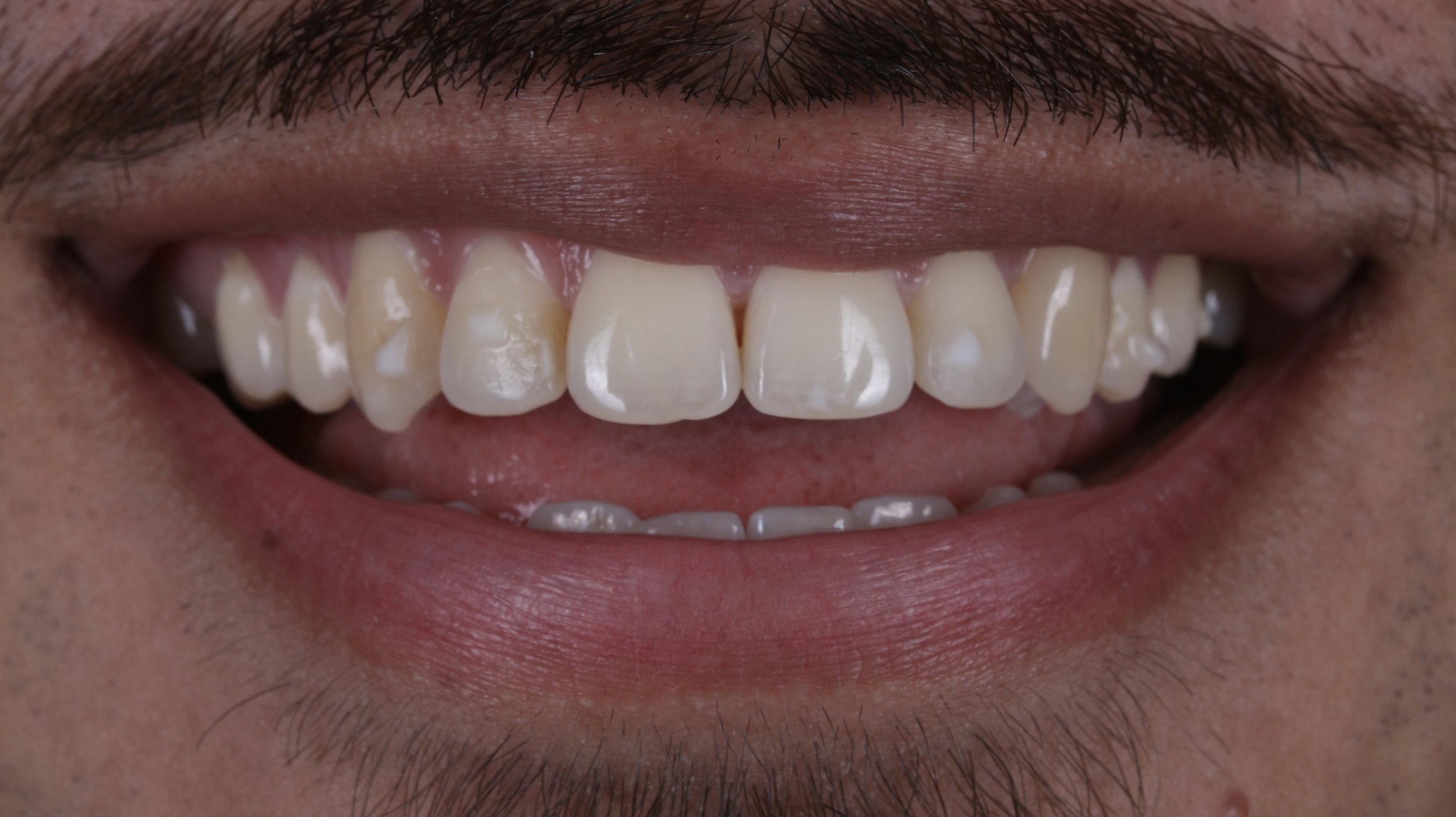 Invisalign Attachments: What They Look Like, Why They Matter, and How to Stop Worrying About Them