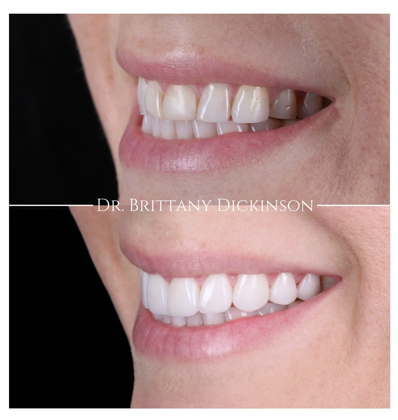 Cosmetic Bonding for a Chipped Front Tooth: When It's the Right Fix (And When It Isn't)
