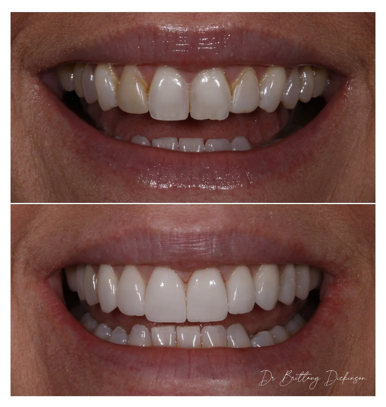 How Much Do Veneers Actually Cost in Chicago? A Transparent Breakdown