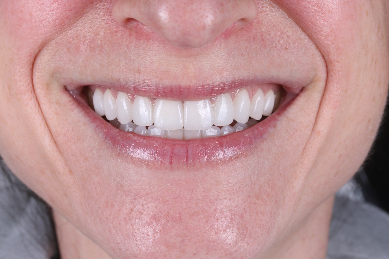 Can You Do Invisalign If You Already Have Veneers, Crowns, or Bonding? What Cosmetic Patients Need to Know