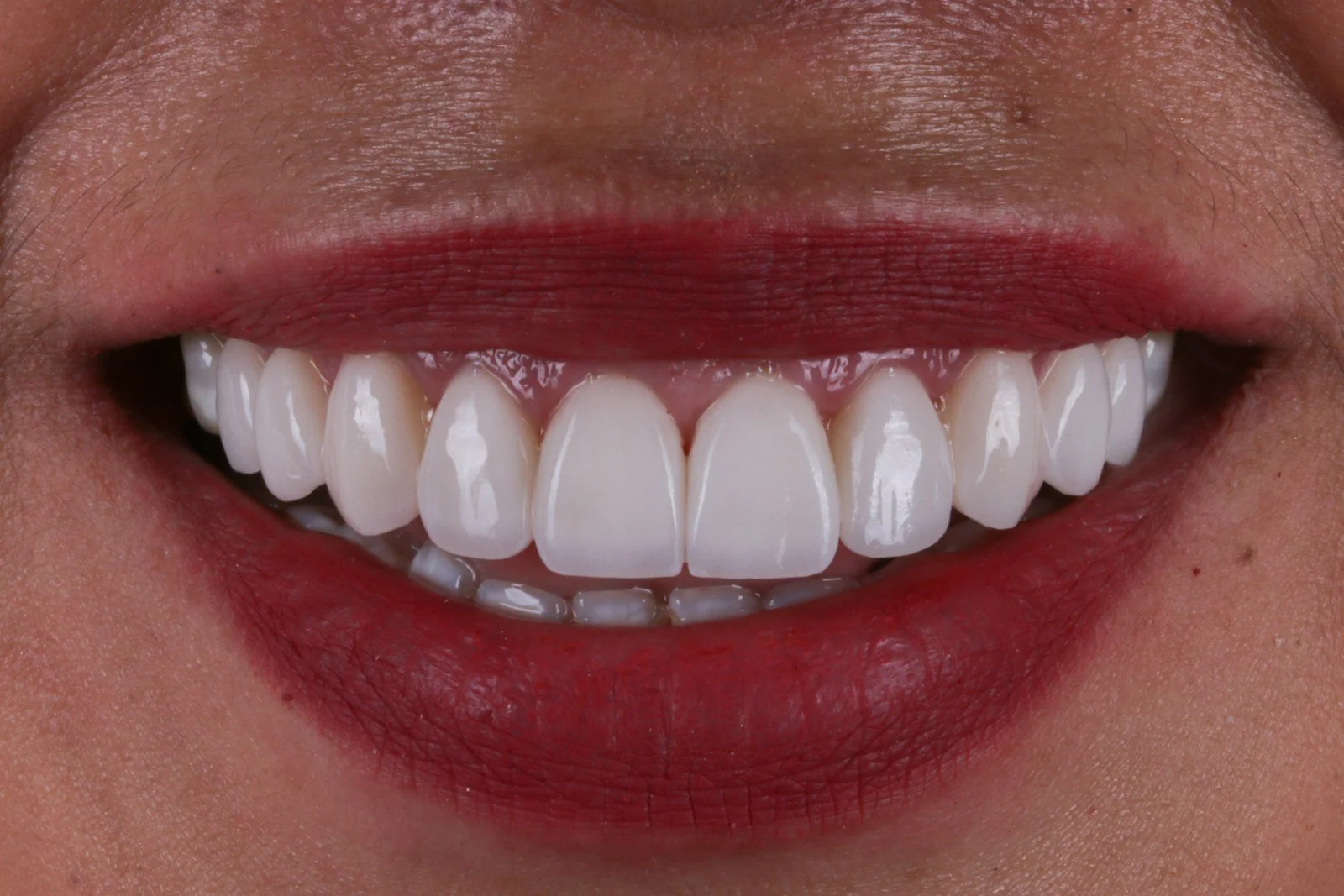 KöR vs. Zoom Whitening in Chicago: Which One Is Actually Right for Your Smile?