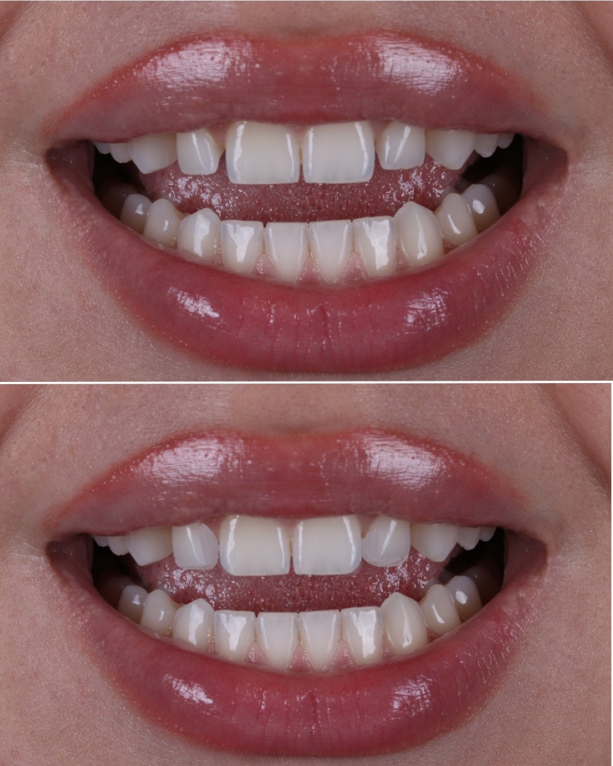 2 porcelain veneers before and after by Dr. Brittany Dickinson, Chicago Aesthetic Dentistry, Lakeview.
