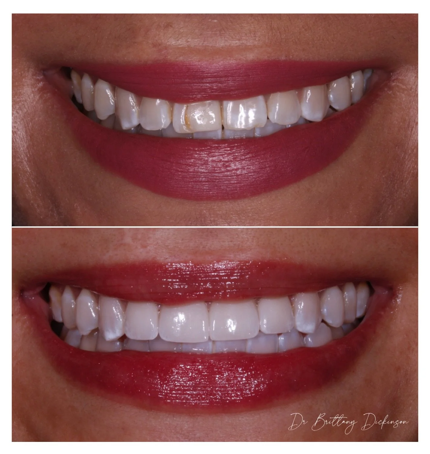 $ porcelain veneers by cosmetic dentist Dr. Brittanty Dickinson in Chicago.