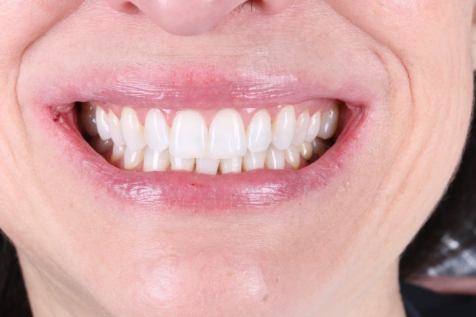 Conservative veneers preserve your natural enamel. A Chicago cosmetic dentist explains what minimally invasive means and why it protects your smile long-term.
