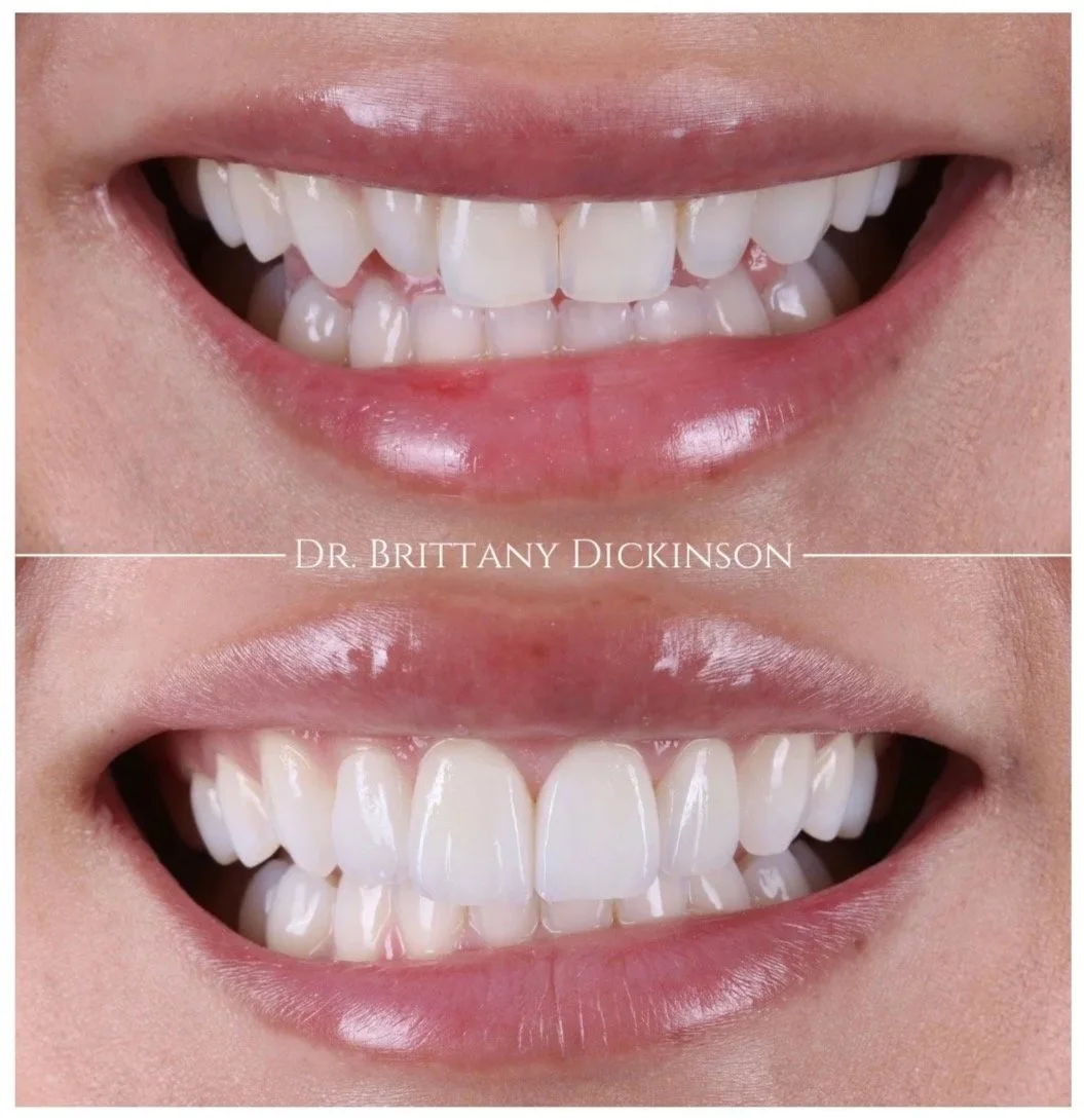 Before and after smile makeover with porcelain veneers at Chicago Aesthetic Dentistry, Lakeview Chicago.