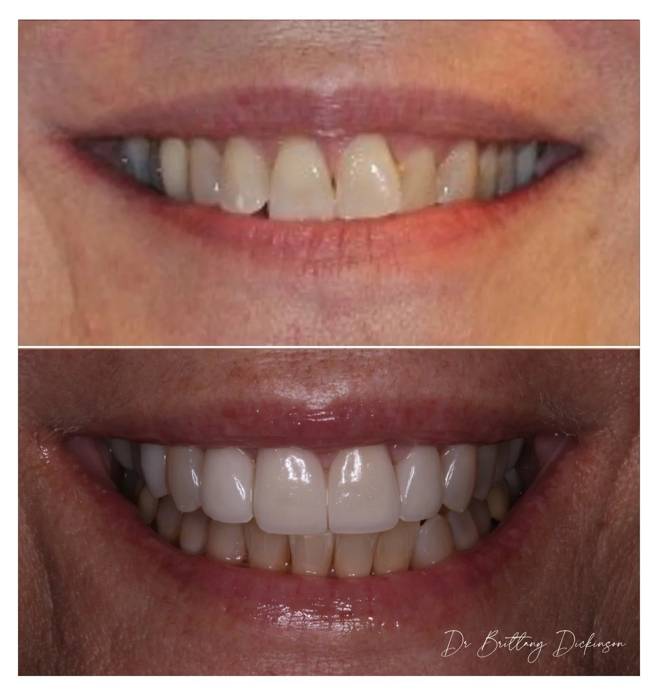 Cosmetic patient brushes porcelain veneers with soft-bristle toothbrush — Chicago cosmetic dentist veneer maintenance guide.