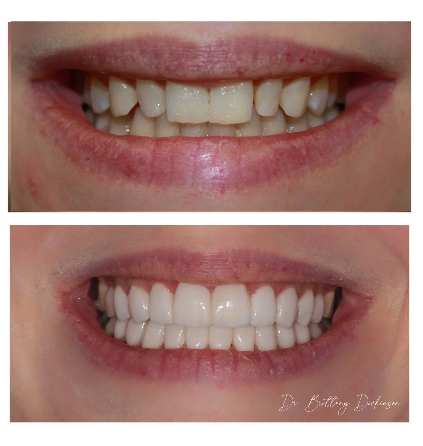 24 porcelain veneers before and after by Dr. Brittany Dickinson, Chicago Aesthetic Dentistry, Lakeview.