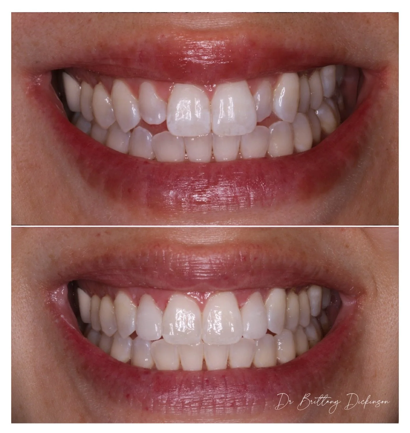 Invisalign, zoom whitening and 2 porcelain veneers before and after by Dr. Brittany Dickinson, Chicago Aesthetic Dentistry.