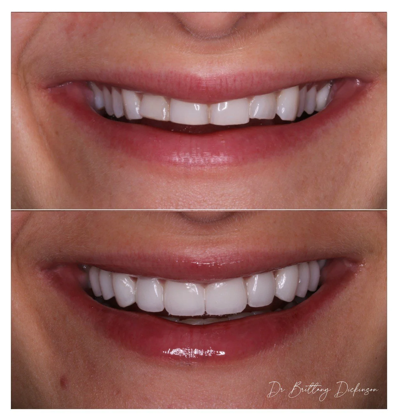 smile makeover before and after