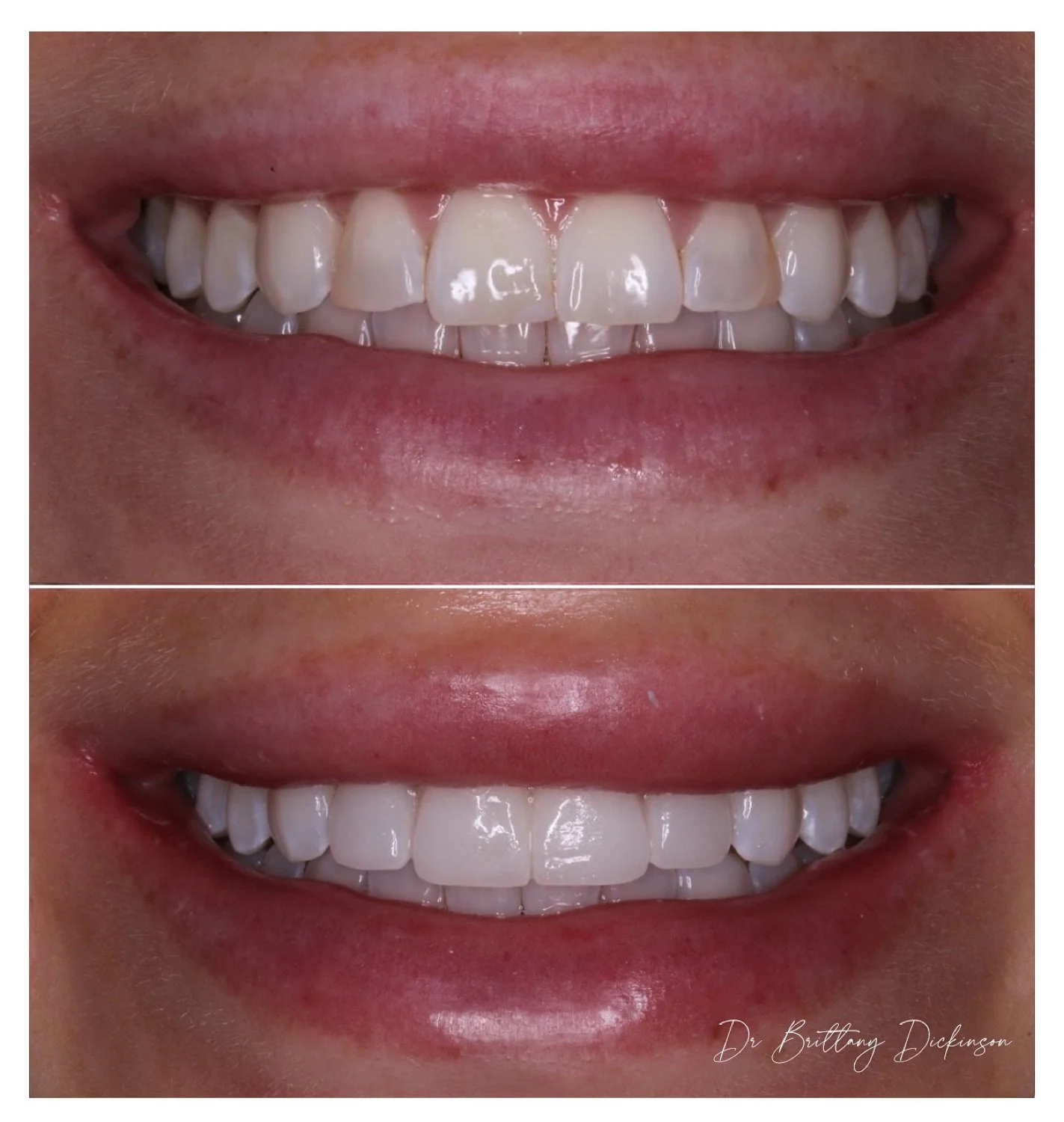 Zoom whitening and 4 porcelain veneers before and after by Dr. Brittany Dickinson, Chicago Aesthetic Dentistry, Lakeview.