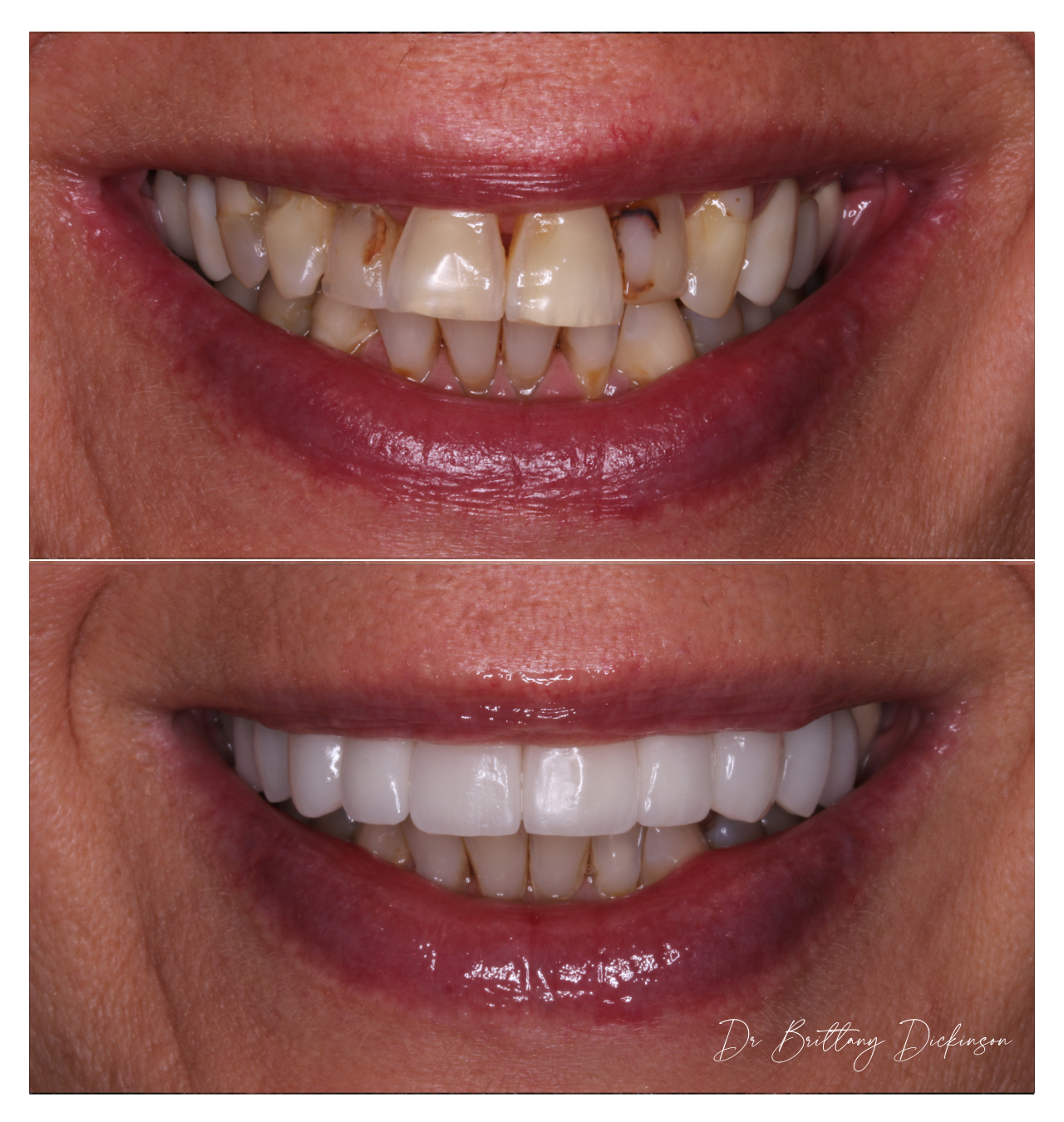 Cosmetic Dentistry for Anxious Patients: How to Get the Smile You Want Without the Fear You Dread