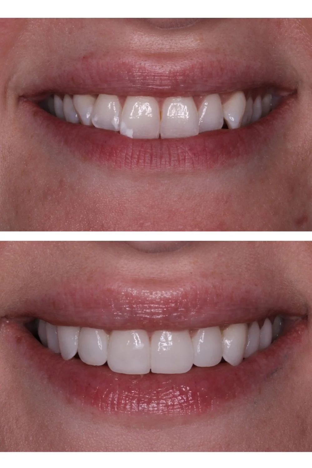 10 porcelain veneers before and after by Dr. Brittany Dickinson, Chicago Aesthetic Dentistry, Lakeview.