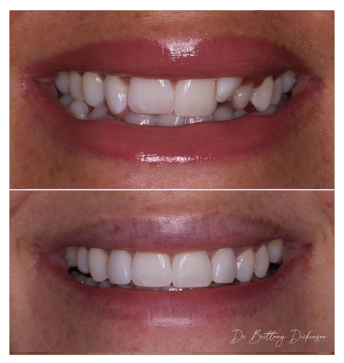 Clear Invisalign aligner held in hand at Chicago Aesthetic Dentistry in Lakeview, alongside traditional braces — adult orthodontic comparison.