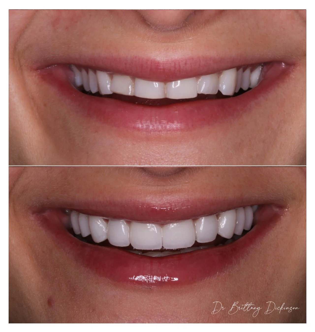 Full smile transformation using porcelain veneers and gum reshaping, Lakeview Chicago cosmetic dentist.