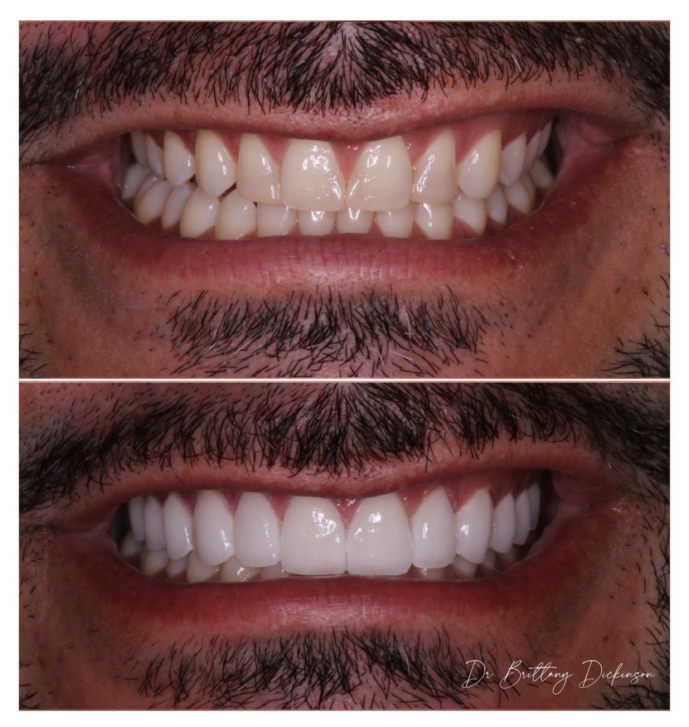 Invisalign, whitening, and 10 porcelain veneers to jump a crossbite and close gaps by Dr. Brittany Dickinson, Chicago.